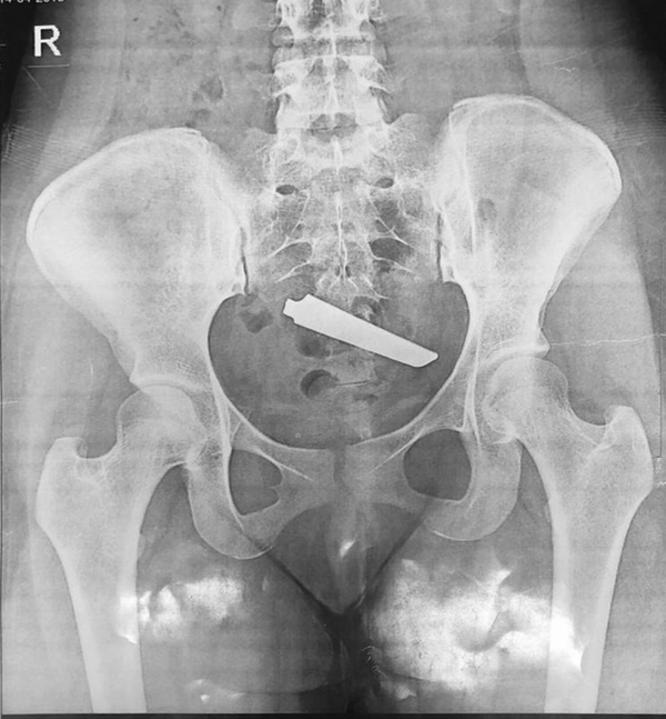 Abdominal X-ray showing knife blade at lower GI tract ruptured intestine