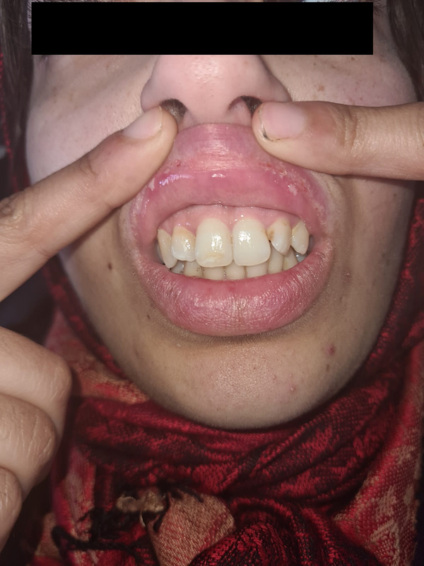 Oral rounded ulcers, with well-defined margins, a white base and surrounding erythema, and non-follicular pustules on the face