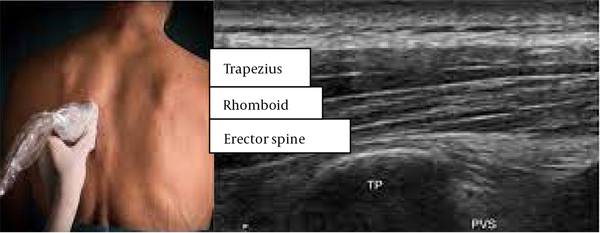 A longitudinal parasagittal view presenting the transverse process of the thoracic vertebrae, the erector spinae muscle, and the trapezius muscle overlying it.