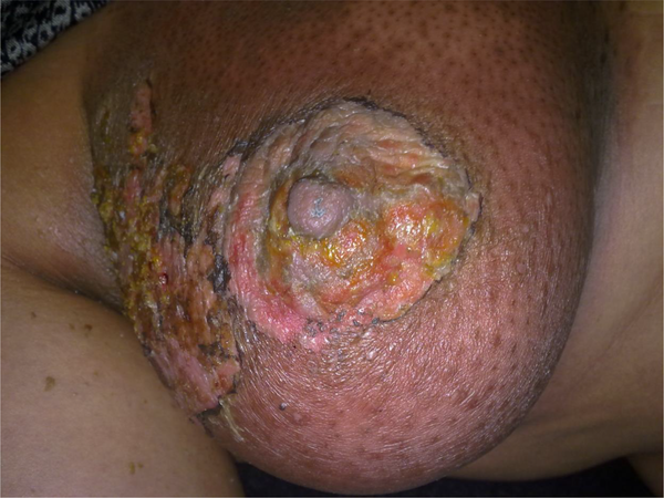 A patient with dermatitis RTOG score 4