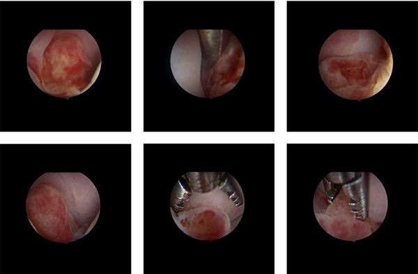 Hysteroscopic view of the RMS tumor