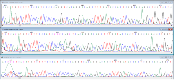 Sequencing data analysis. The patient carries a homozygous nonsense mutation (p.A107fs:c.319-329del) (C: afflicted son). The sequence of the child of codon 304, which shows the deletion of phenylalanine in exon 10, which is in the red circle, is characteristic of heterozygous form, and the time of displacement of an adenine instead of guanine in codon 349.