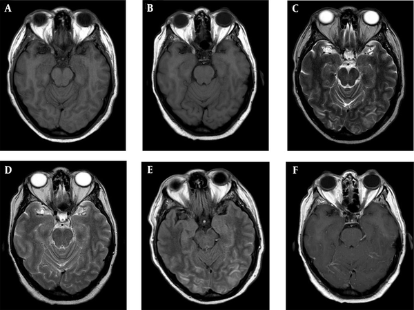 Comparison of head magnetic resonance imaging during posterior reversible encephalopathy syndrome (PRES) development and PRES resolution, respectively, in sequences T1 (A and B), T2 (C and D), and fluid-attenuated inversion recovery (E and F)
