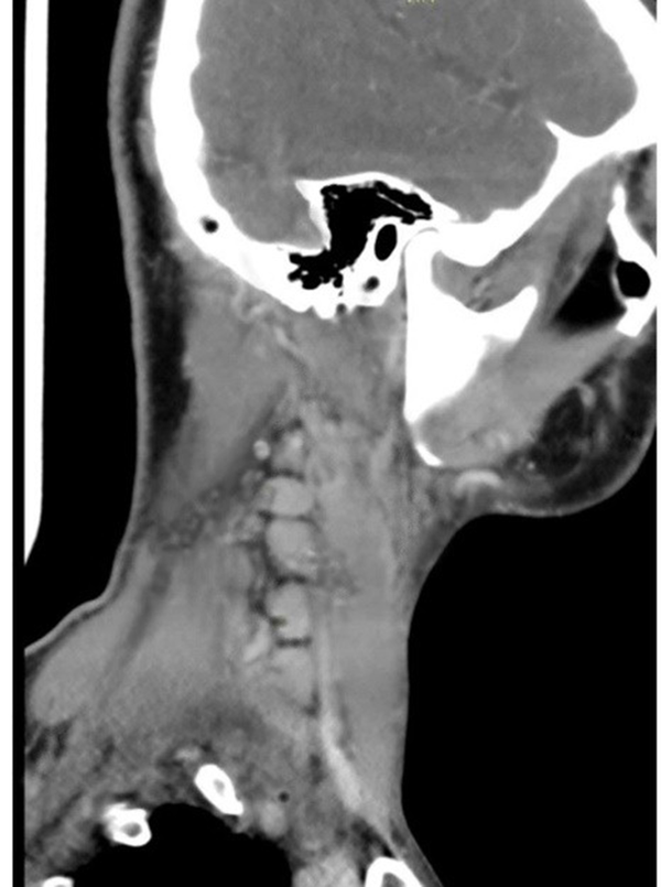 CT scan of the neck shows multiple right profound cervical lymphadenopathy in the right posterior triangle, the largest of which is 1.6 cm with central necrosis