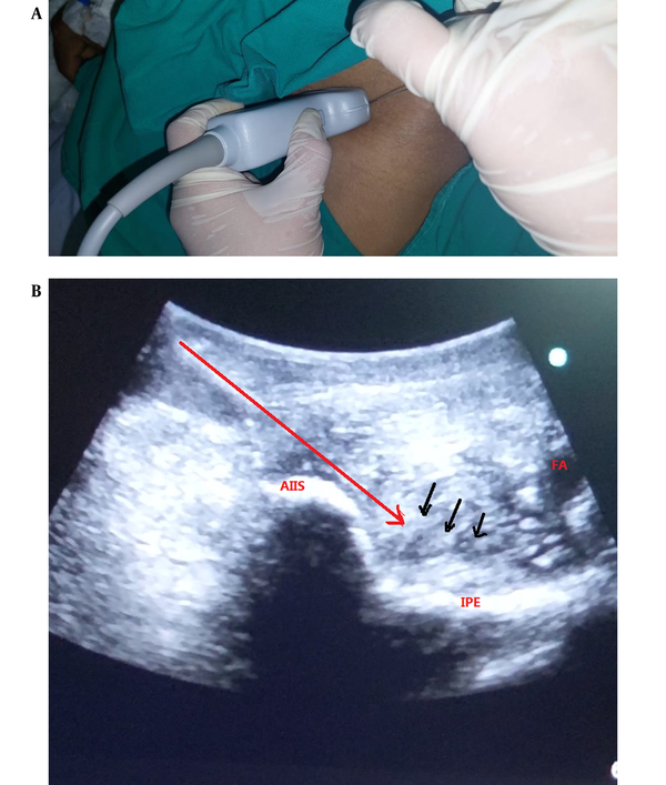 (A) The site of ultrasound probe placement in PENG. (B) Ultrasound-guided pericapsular nerve group (PENG) block. Red arrows: The lateral-to-medial insertion of the needle, AIIS: Anterior inferior iliac spine, IPE: Ilio-pubic eminence, FA: Femoral artery, Black arrow: The spread of local anesthetics.