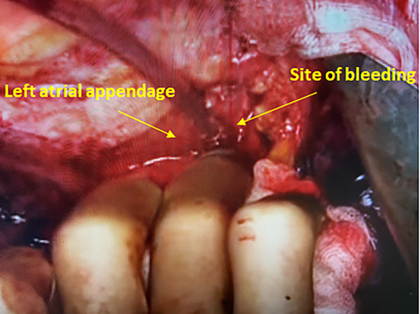 Operative view of the repaired left atrial appendage