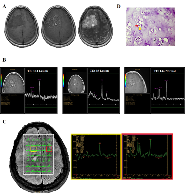  A 26-year-old woman with a chronic headache. A, Conventional MRI. B, Single-voxel spectroscopy (SVS). C, Multi-voxel MRS. D, Histopathologic examination shows the presence of mature cartilage tissue with a lobular architecture and bland-looking chondrocytes (red arrow), located in the lacuna (yellow arrow), confirming chondroma (H&E staining, 400 × magnification).
