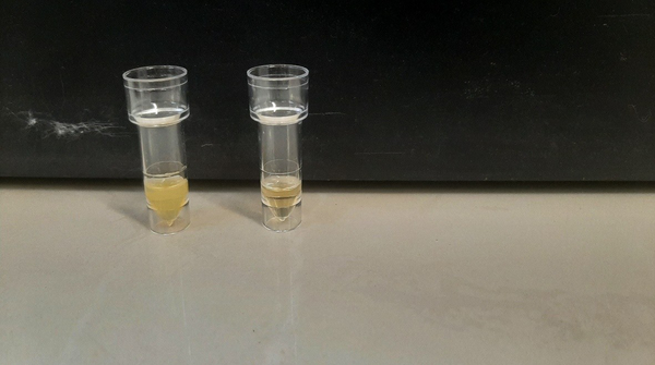Photo of blood sample of the hyperlipidemic patient obtained by centrifugation in admission vs. blood sample after 3 days treatment