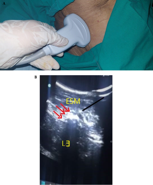 (A) The site of ultrasound probe placement in ESPB. (B) Ultrasound-guided lumbar erector spinae block. Erector spinae muscles, L3: The transverse process of the third lumbar vertebra, red arrows: The spread of local anesthetics.