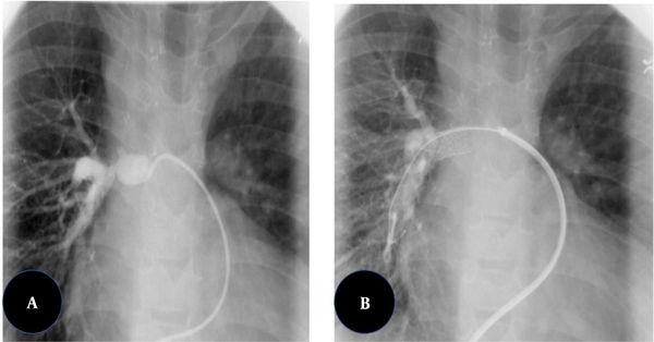 Results Of Transcatheter Therapy With Balloon Versus Stent For Treating ...