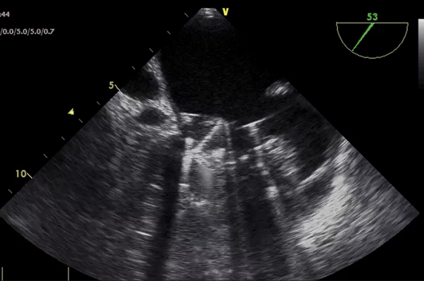Obstruction of the anterior hemidisc of the prosthetic mitral valve in a mid-esophageal 4-chamber view of transesophageal echocardiography