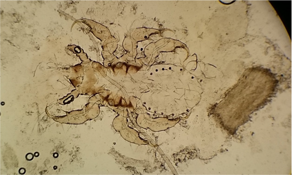 Six-legged nymph (according to appearance, the third nymph) of Pediculus humanus capitis attached by its claws to a hair. Next to the nymph, there is a dystrophic hair parasitized by fungal spores (endothrix). The sections are visualized using 10% potassium hydroxide under light microscopy at 200X magnification