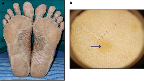 A: Hyperkeratotic scaly plaques (PRP sandal) distributed symmetrically over both soles, B: Dermoscopy findings in PRP, showing homogenous structure with less orange areas (the purple arrow) (Heine delta 20+, 20x).
