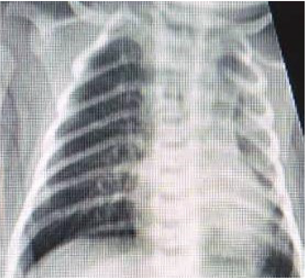 The chest X-ray of case 1 shows diffuse opacity and haziness in the left lung