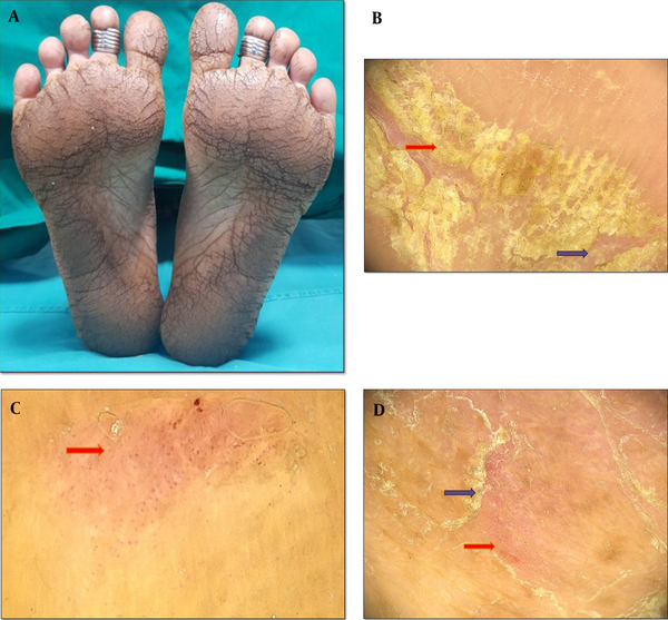 A: Hyperkeratotic scaly eczematous plaques with fissures distributed symmetrically over the plantar aspect of feet, B: Dermoscopy findings of palmoplantar dermatitis showing patchy yellow (red) and white (purple) scales, C: Dermoscopy examination showing dotted vessels (red) with a patchy distribution behind a light-red background, D: Dermoscopy examination showing dotted vessels (the red arrow) in with clustered distribution and peripheral scales (the purple arrow) (Medicam1000, 20x).