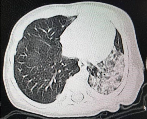 The chest computed tomography scan of patient 10 shows ground glass appearance and consolidative pulmonary opacities in favor of COVID-19