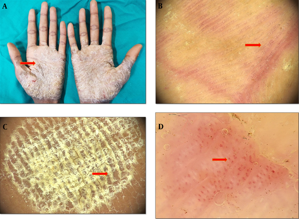 A: Erythematous scaly plaques of psoriasis distributed symmetrically over the palms, B: Dermoscopy features of palmoplantar psoriasis, showing regular dotted vessels (the red arrow), C: Dermoscopy features of palmoplantar psoriasis, showing characteristic diffused white scales (the red arrow) with a dull-red background, D: Dermoscopy findings showing irregularly spaced rows of glomerular vessels (the red arrow) (Medicam1000, 20x).
