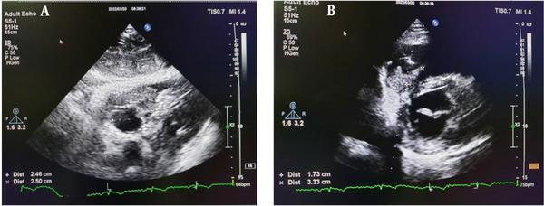 Transthoracic echocardiography (left, subcostal four-chamber view; right, parasternal short axis view).