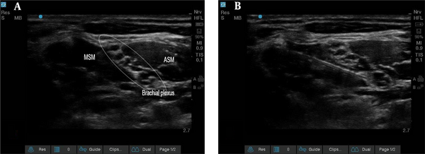 Sonography of the brachial plexus, middle scalene muscle, and anterior scalene muscle. The b and a are before and after the injection, respectively (Abbreviations: MSM, middle scalene muscle; ASM, anterior scalene muscle).