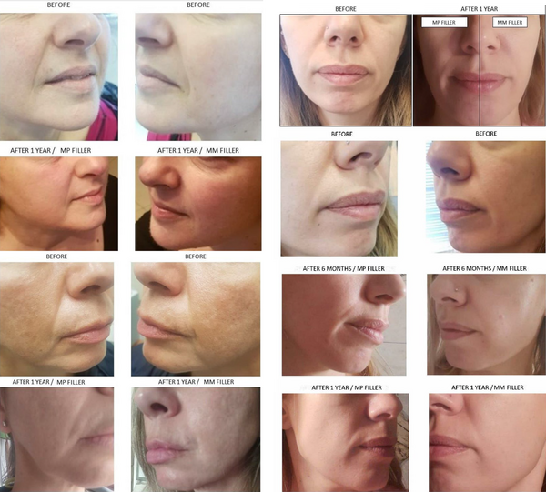 Random case citations depicting a noticeable and time-sustained cosmetic result in both nasolabial folds (NFs), indifferently of the hyaluronic acid (HA) used type