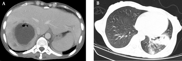 A, abdominopelvic CT scan with contrast, a 63 × 63 mm unilocular, non-enhancing, and hypodense lesion with ill-defined borders, with surrounding edema and air focus in the V hepatic segment; B, spiral lung CT scan, consolidation in the left lower lobe accompanied by an interpulmonary abscess measuring 71 × 22 mm and centriacinar nodular opacities.