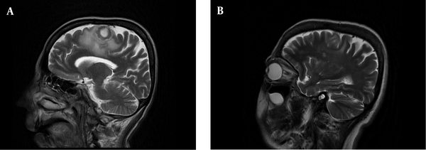 Brain MRI, sagittal view, T2-weighted imaging. A, initial imaging, midsagittal cortical and subcortical left light frontal convexity cystic lesion with ring enhancement and restriction diffusion, as well as surrounding perilesional edema; B, follow-up imaging after 6 months; the lesions are obviously improved.