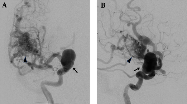 A 64-year-old woman experienced a brief loss of consciousness following a head injury. A subsequent brain CT scan revealed a subarachnoid hemorrhage (SAH). Additionally, large aneurysms were incidentally discovered in the bilateral dorsal internal carotid arteries, along with an arteriovenous malformation (AVM) in the right temporal lobe. The angiogram of the right internal carotid artery with anteroposterior (A) and lateral (B) views showed right temporal AVM (arrowhead) and right supraclinoid ICA aneurysm (arrow).