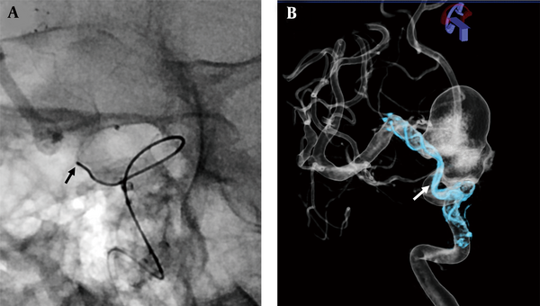 A, The guidewire failed to advance over the stenotic site of the Flow Redirection Endoluminal Device (FRED) (black arrow); B, The 3D rotational angiography with multi-planar reformatted image revealed the twisting stenotic site of the FRED (white arrow).