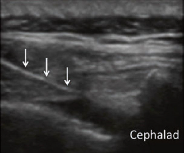 The caudal ESI ultrasound view
