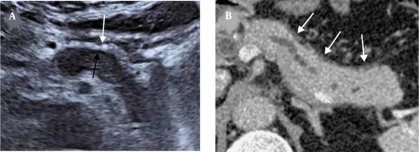A 62-year-old man with AIP1. A, The US image shows a thick hyperechoic capsule (white arrow) and a thin PHM (black arrow) around the lesion. B, The capsule-like rim sign on the CT scan (white arrows). The thickness of the hyperechoic capsule on the US image is similar to that of the capsule-like rim on the CT scan (0.49 cm vs. 0.51 cm) (AIP1, type 1 autoimmune pancreatitis; US, ultrasonography; PHM, peripancreatic hypoechoic margin; CT, computed tomography).