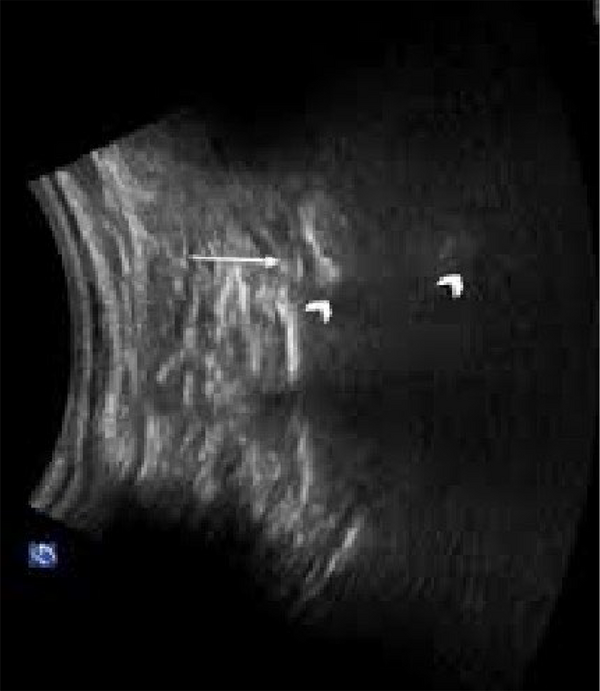 The S1 transforaminal view in ultrasound