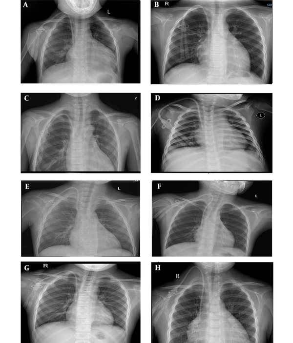 Establishing Long-Term Haemodialysis Vascular Access with Permcath in ...