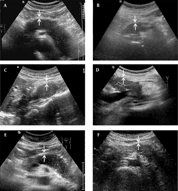 The ultrasonography (US) images of AIP1 and PAC cases. Both AIP1 (A, C & E) and PAC (B, D, F) present as hypoechoic lesions, which involve the entire pancreas (A & B) or are located at the pancreatic head/uncinate process (C & D) or body and tail (E & F). The thickness of the hyperechoic capsule-like structure (arrows) is different between the case and control groups. It is often > 0.41 cm in the AIP1 group (A, 0.43 cm; C, 0.49 cm; E, 0.42 cm) and <0.41 cm in the PAC group (B, 0.24 cm; D, 0.24 cm; F, 0.32 cm) (AIP1, type 1 autoimmune pancreatitis; PAC, pancreatic adenocarcinoma).