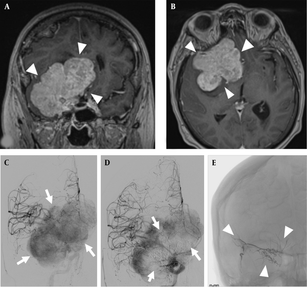 A and B, giant meningioma of the right greater sphenoid wing (arrowheads), coronal and transverse contrast-enhanced T1-weighted images; C, DSA with injection into the right common carotid artery showing a significant tumor blush in the late arterial phase (arrows); D, DSA with injection again into the right common carotid artery after embolization with a significant reduction in tumor blush in the center of the meningioma (arrows); E, radiograph without contrast injection showing the liquid embolic agent in the center of the tumor (arrowheads).