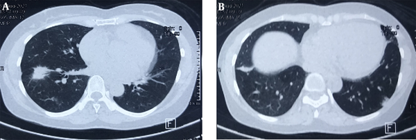 Weekly Afatinib in the Treatment of Advanced Non-small Cell Lung Cancer ...