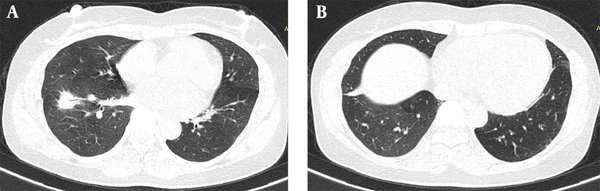 Weekly Afatinib in the Treatment of Advanced Non-small Cell Lung Cancer ...