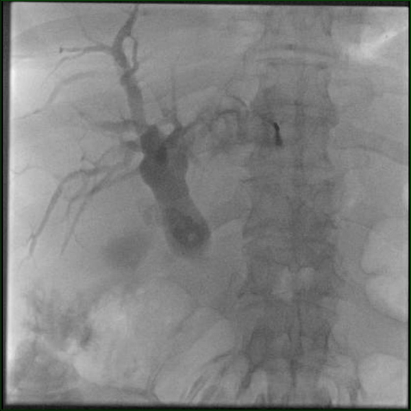 A Rare Indication for Percutaneous Transhepatic Cholangiography ...