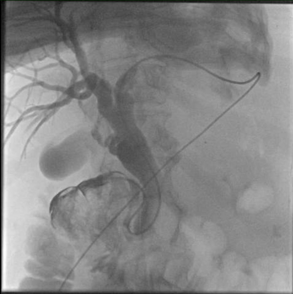 A Rare Indication for Percutaneous Transhepatic Cholangiography ...