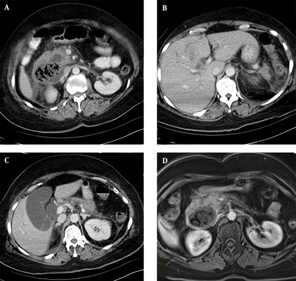 A Rare Indication for Percutaneous Transhepatic Cholangiography ...