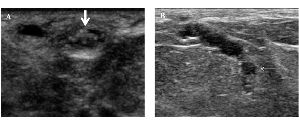 Sonography of the left breast shows two cystic lesions, one in the subcutaneous plane (solid arrow) (A) and the other in the fatty breast parenchyma (line arrow) (B), both showing multiple curvilinear echoes with a dilated interconnecting tubular channel.