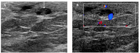 A, Follow-up ultrasound showed prominence of lymphatic channels with linear echoes (arrow), and loss of twirling movement (dead worms). B, the color motion artifact was not seen.