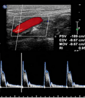 Compensatory Hemodynamics in Severe Unilateral Internal Carotid Artery Stenosis: A Case Report