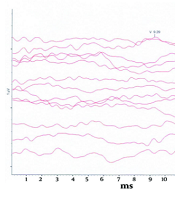 Unilateral Sensorineural Hearing Loss in Johnson-Blizzard Syndrome: A Rare Case Report