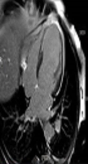 Correlations of T2* Mapping with Delayed Gadolinium Enhancement in Magnetic Resonance Imaging of Chronic Myocardial Infarction