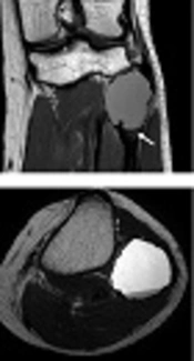 Simple Bone Cyst with Mesenchymal Proliferation Involving Epiphysis of the Proximal Fibula: A Case Report