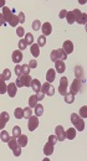 How Azithromycin Could Effect on Airflow Decline Free Survival After Allogeneic Hematopoietic Stem Cell Transplant