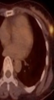 Invasive Cribriform Carcinoma of the Breast: Radiologic and Histopathologic Features