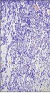 Expression of Pro-Apoptotic P53 Tumor Suppressor Gene in Pituitary Adenomas: Comparison with Anti-Apoptotic Bcl-2 Oncoprotein