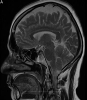 Int Cardiovasc Res J