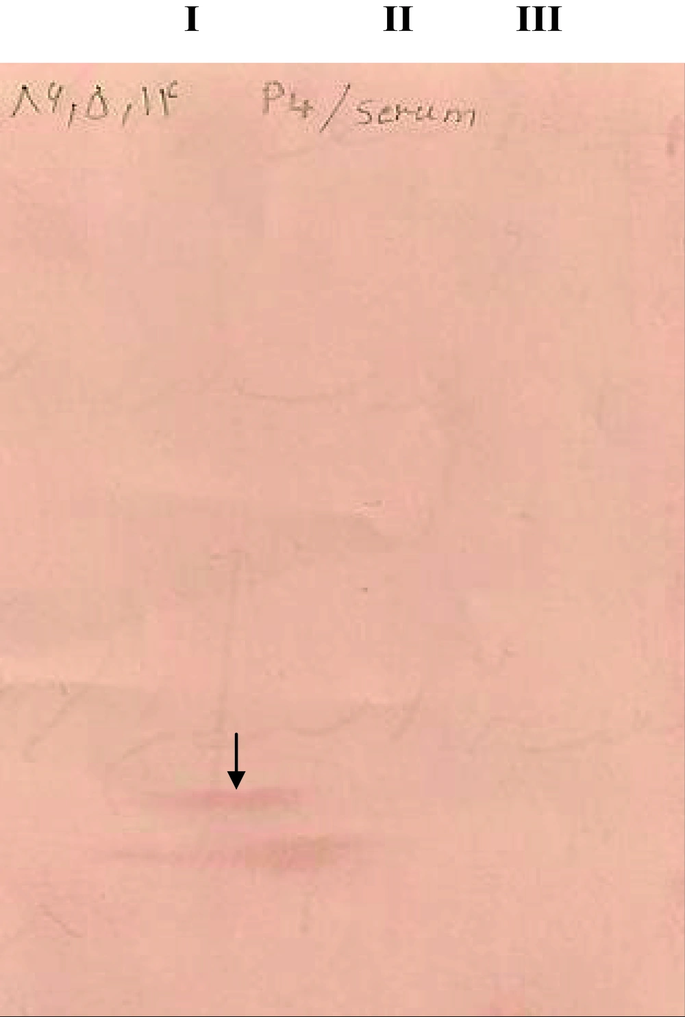 Analyses of Recombinant p4 by Western Blot Using Human Cutaneous Leishmania Serum (L. major) Antibody (1:200) and Rabbit Anti-human IgG HRP Conjugate (1:500), 5 h After Induction Lane I: Bacteria lysate containing recombinant plasmid (rpQE-30), Lane II: Bacteria lysate alone, Lane III: Bacteria lysate containing intact plasmid (pQE-30)